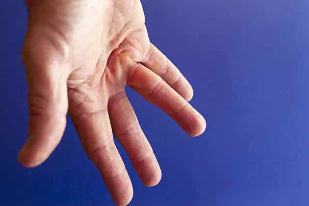 Everything You Need To Know About Dupuytren's Contracture