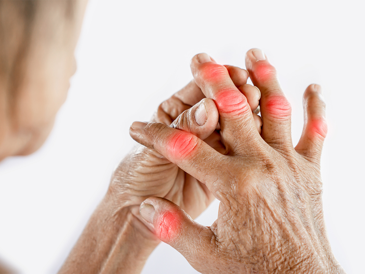 Rheumatoid Arthritis