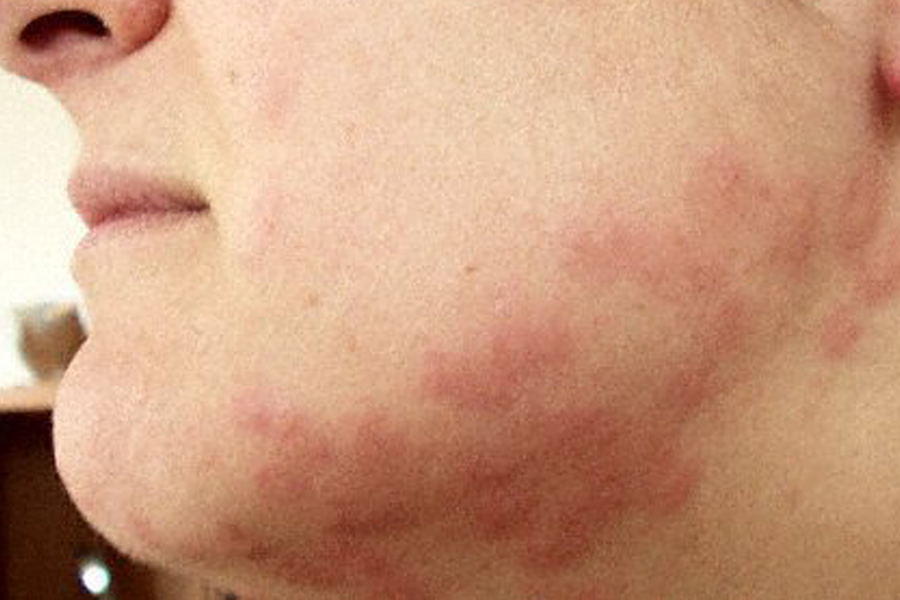 What do bed bug bites look like?