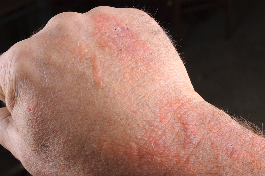 What Causes Poison Ivy Rash To Ooze