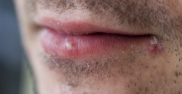 cold-sore-remedies