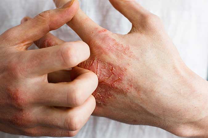 Concerns: Triclosan
