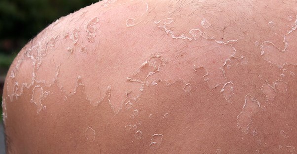 what-s-the-chance-of-getting-skin-cancer-from-a-sunburn