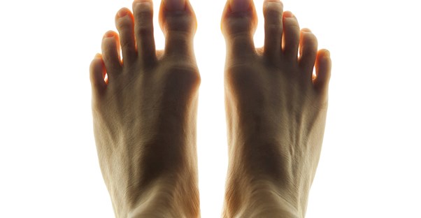 How Much Does Bunion Removal Cost?