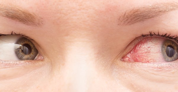 itchy eyes itchy eyes