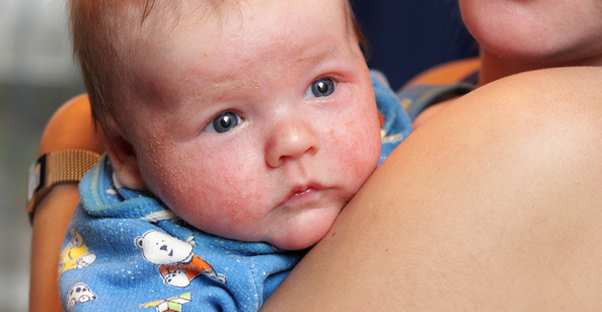 Eczema in Babies