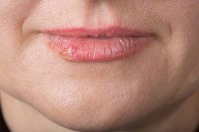 Chapped Lips Symptoms