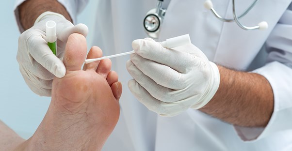 Athlete's Foot Treatments and Remedies