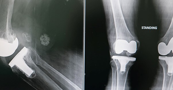 Understanding Different Types of Knee Replacement Surgery