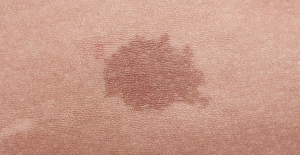 does-your-birthmark-have-a-medical-meaning